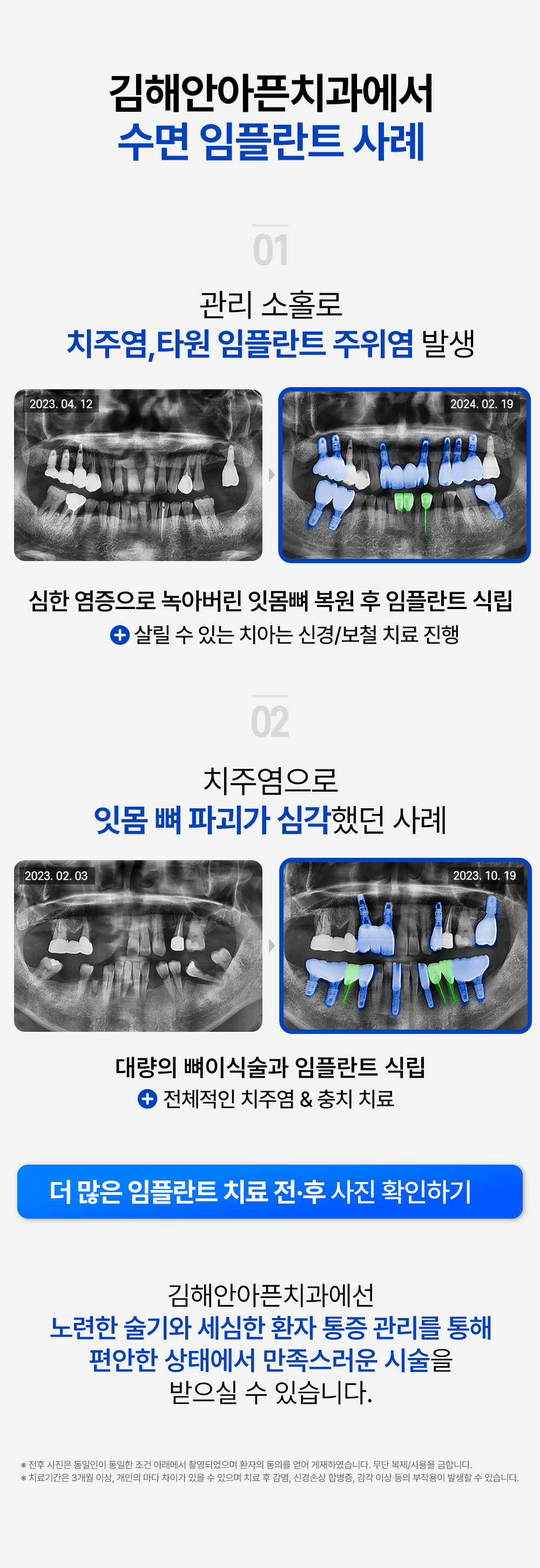 김해안아픈치과 수면 임플란트 사례